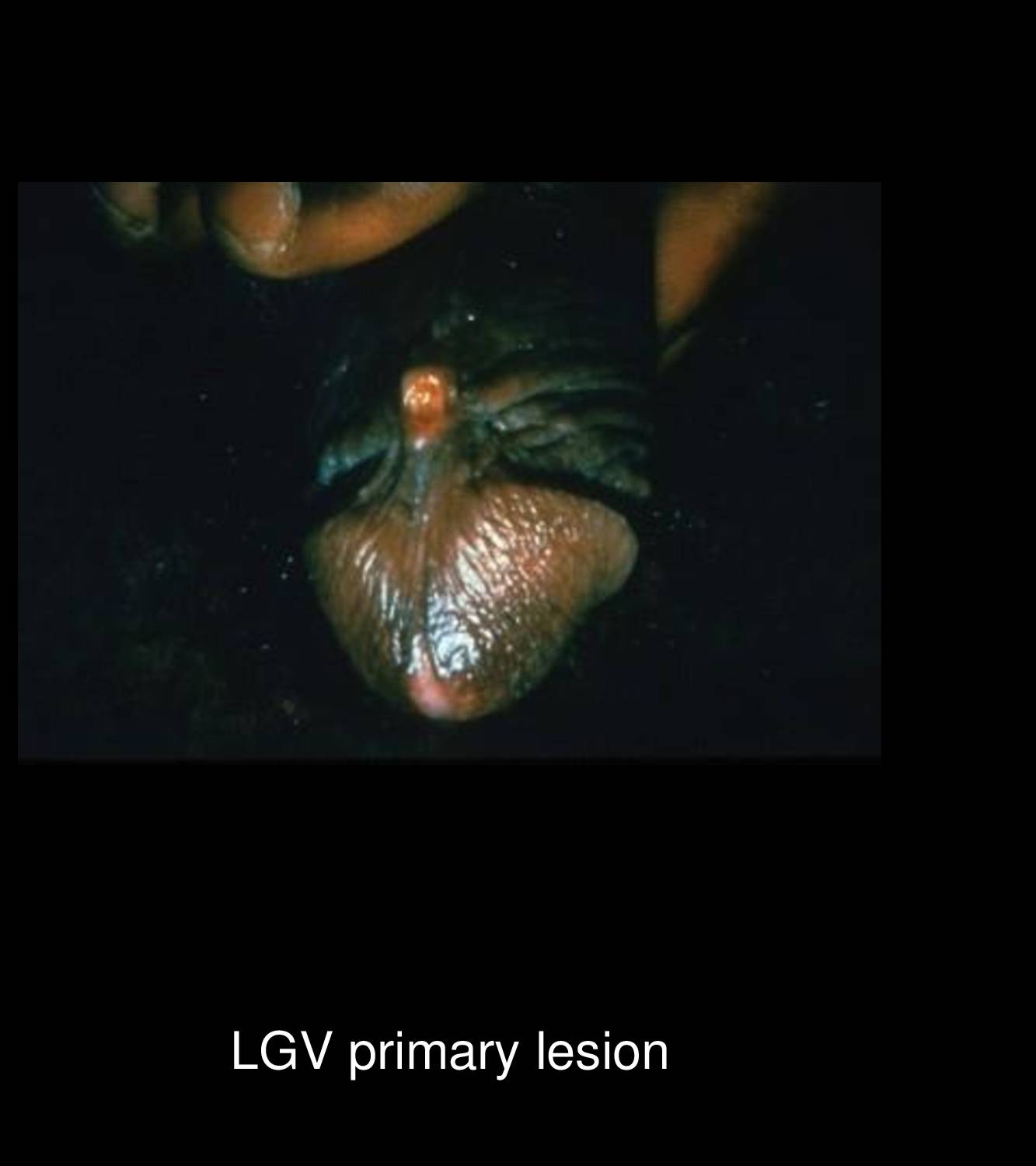 LGV proctocolitis with rectal mucosal inflammation discharge and bleeding in men who have sex with men infected with Chlamydia trachomatis LGV serovars